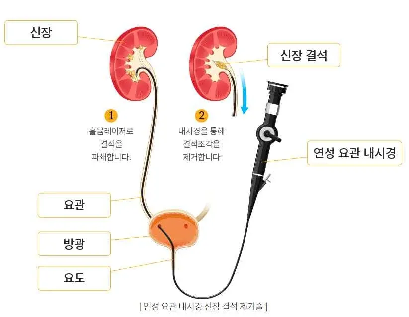 요로계 해부도 — 신장에 생긴 결석을 요도 · 방광 · 요관을 지나 올라간 연성 요관내시경으로 확인하고, 홀뮴 레이저로 파쇄한 뒤 조각을 꺼내는 순서를 보여 주는 그림